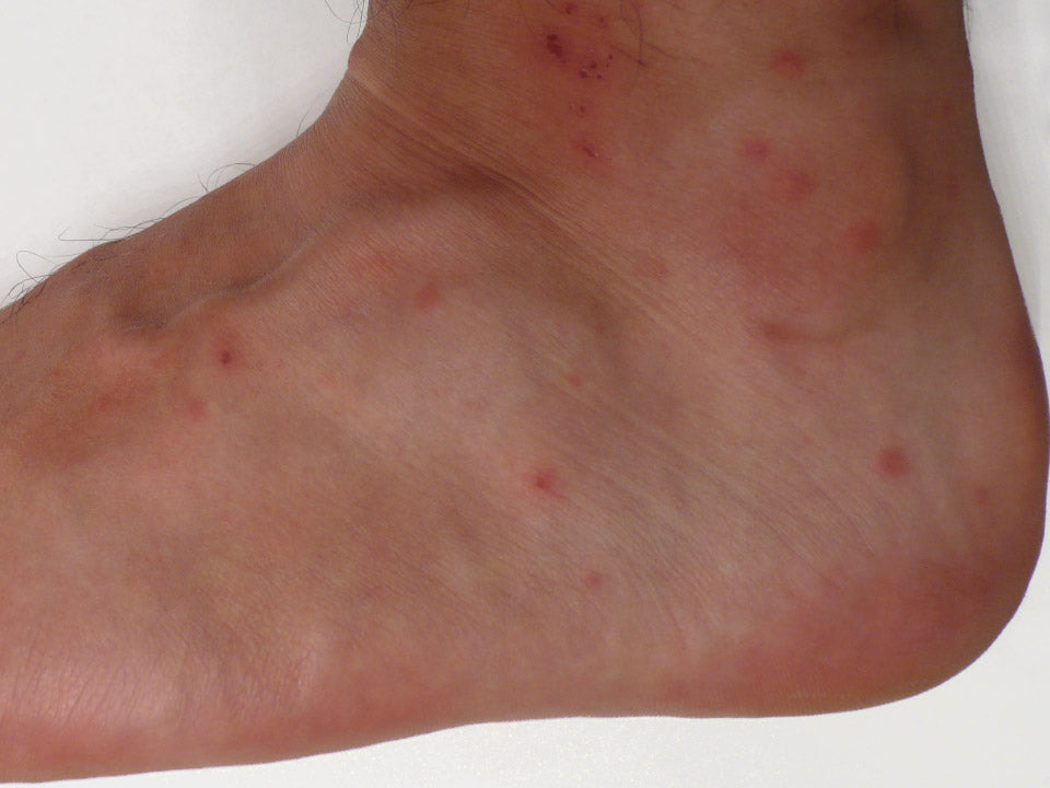 chigger bites on a foot